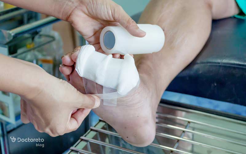 نحوه پانسمان زخم پای دیابتی چگونه است؟