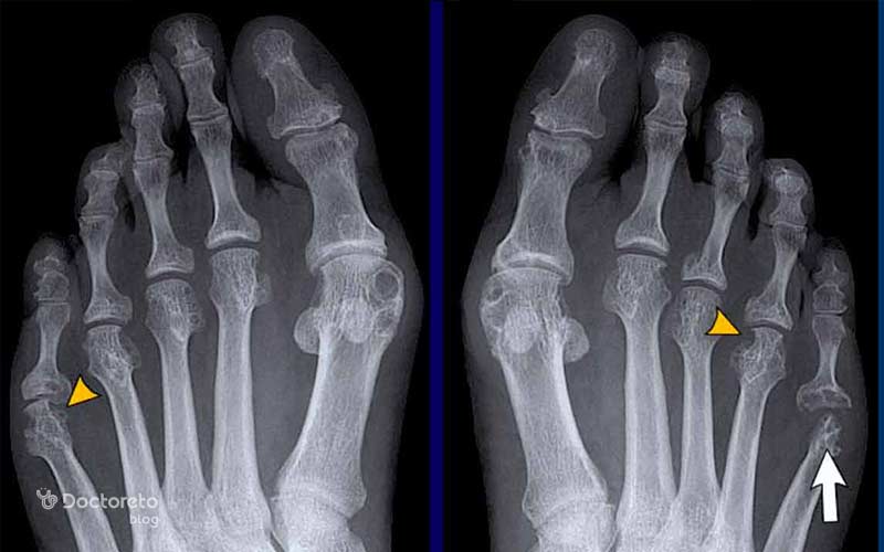 کاهش فاصله مفصلی از یافتههای مهم در X-ray هستند.