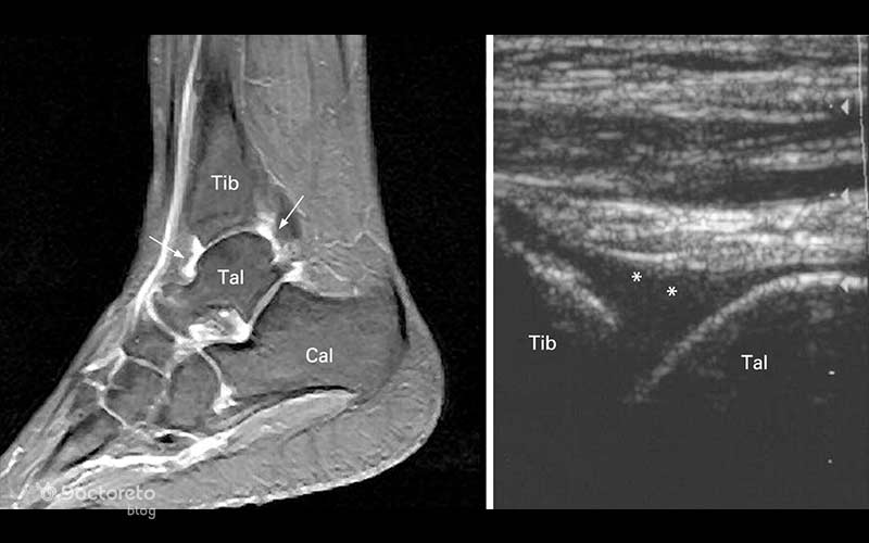 MRI همچنین آسیب تاندونها و رباطها را بهوضوح نمایش میدهد.