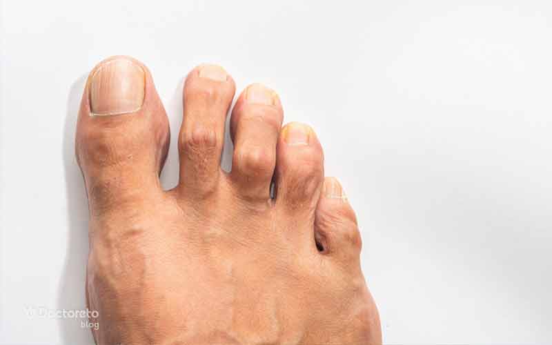 روماتیسم در مراحل اولیه تغییرات خفیفی را نشان میدهد.