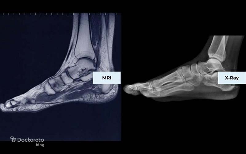 MRI یکی از دقیقترین روشها برای بررسی التهاب مفاصل در روماتیسم پا است.