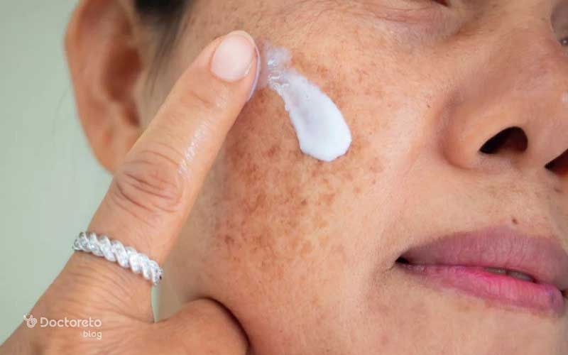 پیشگیری از لک بارداری (ملاسما) چگونه امکانپذیر است؟