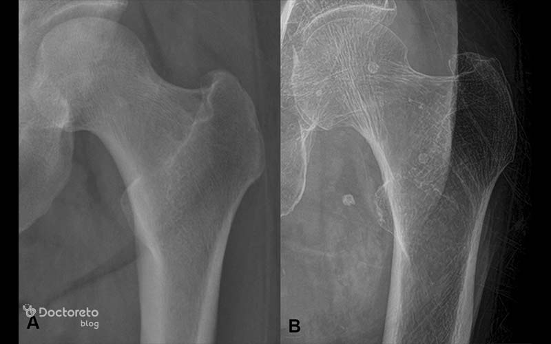 از رادیوگرافی برای تشخیص اولیه پوکی استخوان استفاده میشود.