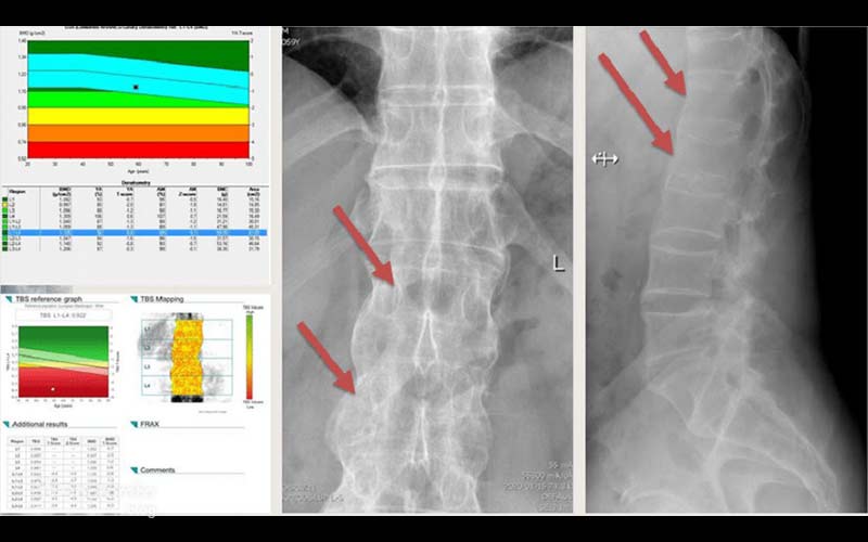 اصلیترین روش تصویربرداری برای تشخیص پوکی استخوان و بررسی BMD، اسکن DXA یا DEXA است.