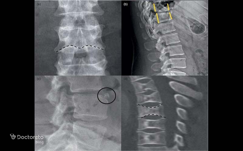 تفسیر عکس پوکی استخوان ستون فقرات برعهده پزشک ارتوپد است.