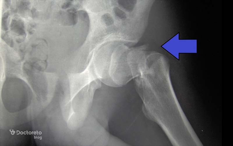 برای تشخیص و بررسی پوکی استخوان در لگن و ران، از روشهای مختلف استفاده میشود.