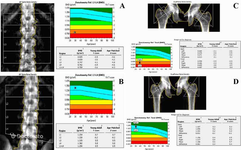 برای تشخیص پوکی استخوان نیاز به روشهای دقیقتری است.