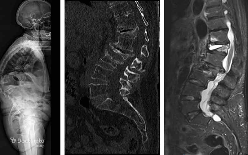 در عکس پوکی استخوان ستون فقرات میتوان شکستگیهای احتمالی در استخوانها را تشخیص داد.