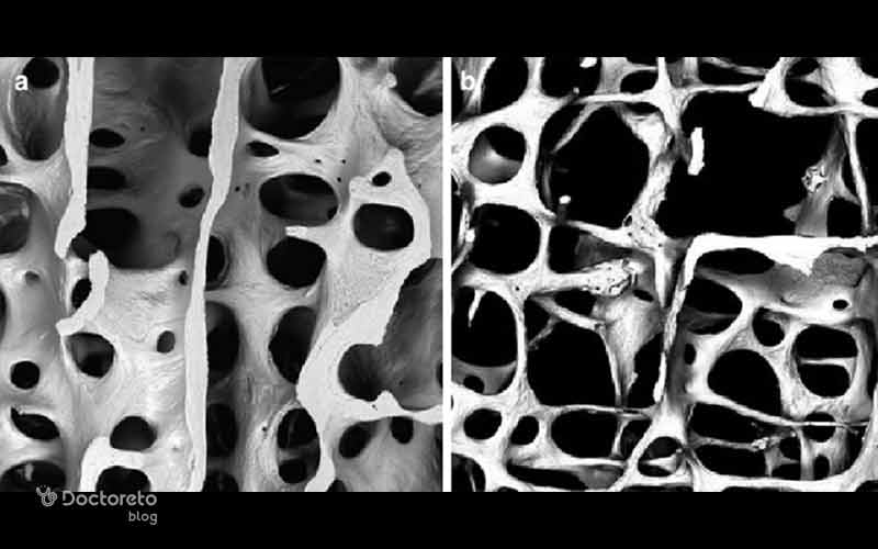 این تصویر مقایسه مستقیم بین استخوان سالم و استخوان با پوکی استخوان را نشان میدهند.