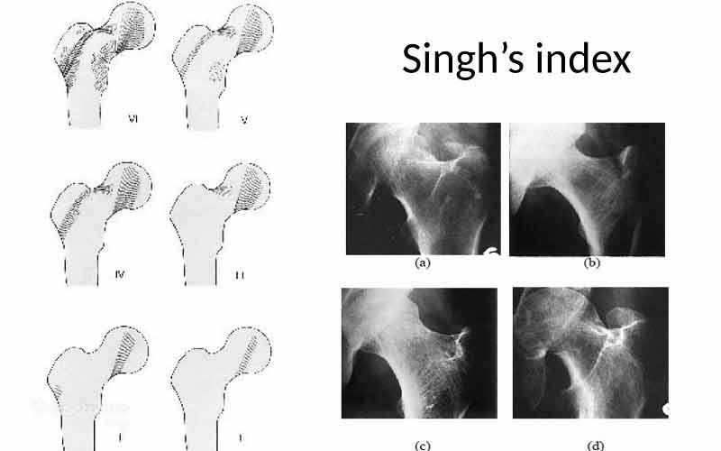 برای سنجش تراکم استخوان باید از روشهای دقیق دیگری استفاده شود.