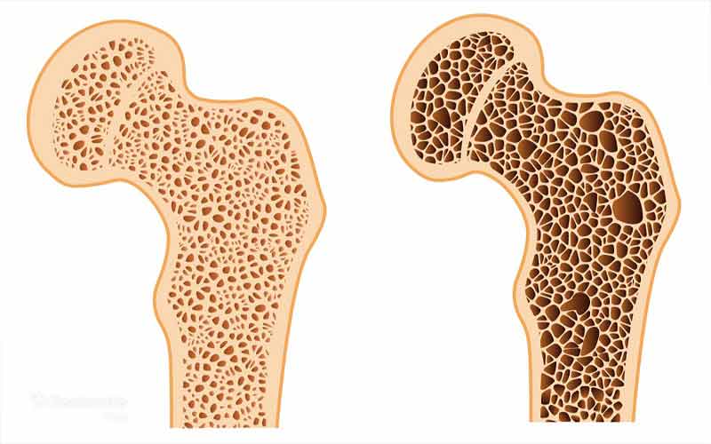 ساختار داخلی استخوان سالم چگالتر است و استخوان پوکی استخوانتر و متخلخلتر به نظر میرسد.