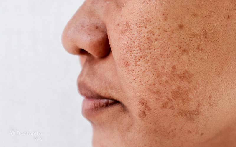 لک بارداری (ملاسما) چه شکلی است و در کدام نواحی ظاهر می شود؟