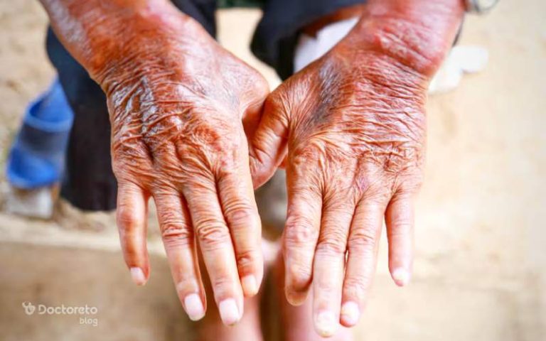 طول عمر بیماران اسکلرودرمی تحت تاثیر چه عواملی است؟