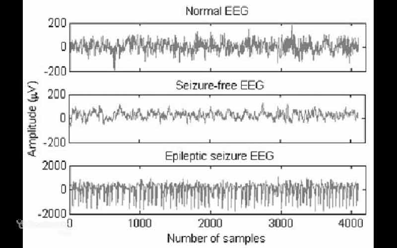 الگوهای مغزی در انواع تشنج متفاوت است.
