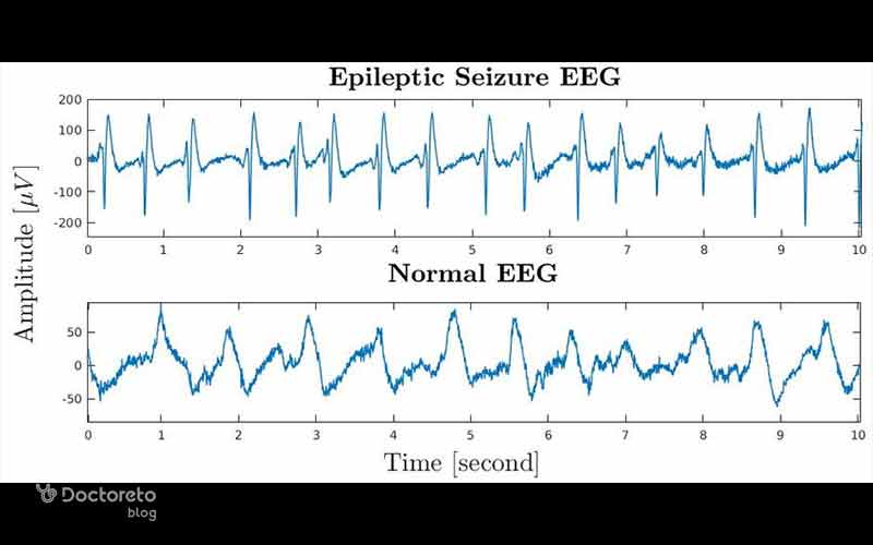 در این تصویر نوار مغز یک فرد سالم با یک فرد تشنجی مقایسه شده است.