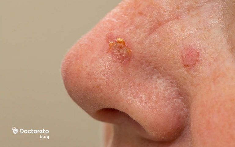 همه چیز درباره سرطان سلول سنگفرشی (SCC)، عوامل خطر و علائم آن