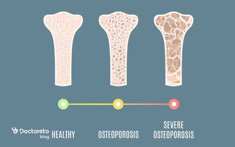 آیا پوکی استخوان خفیف هم میتواند خطرناک باشد؟