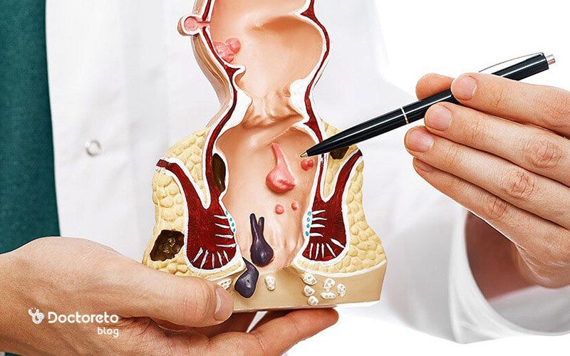 خارش و سوزش علائم اولیه اما آزاردهنده فیستول مقعدی است.