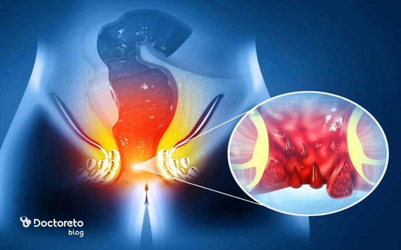 کدام داروها برای درمان فیستول مقعدی موثر است؟