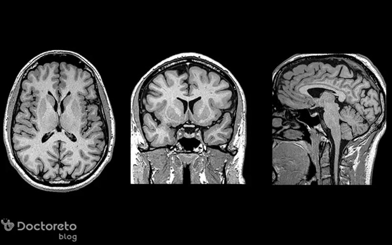 نوار مغز همیشه نشان دهنده تشنج نیست.