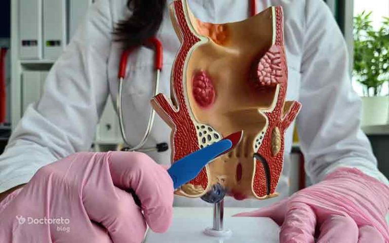 جراحی فیستول مقعدی از معرفی انواع عمل تا مراقبت ها و عوارض