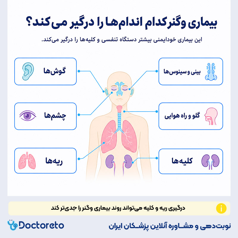 اینفوگرافیک بیماری وگنر