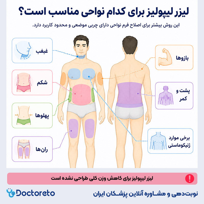 اینفوگرافیک لیزر لیپولیز