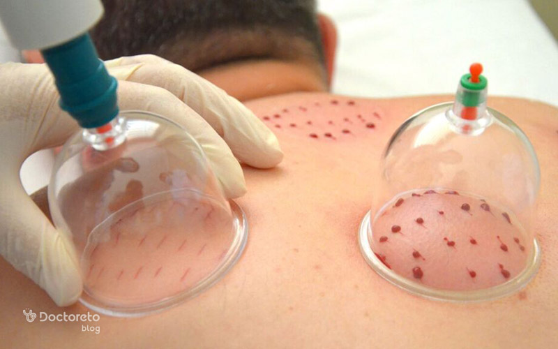 آیا حجامت باعث درمان کبد چرب می‌شود؟