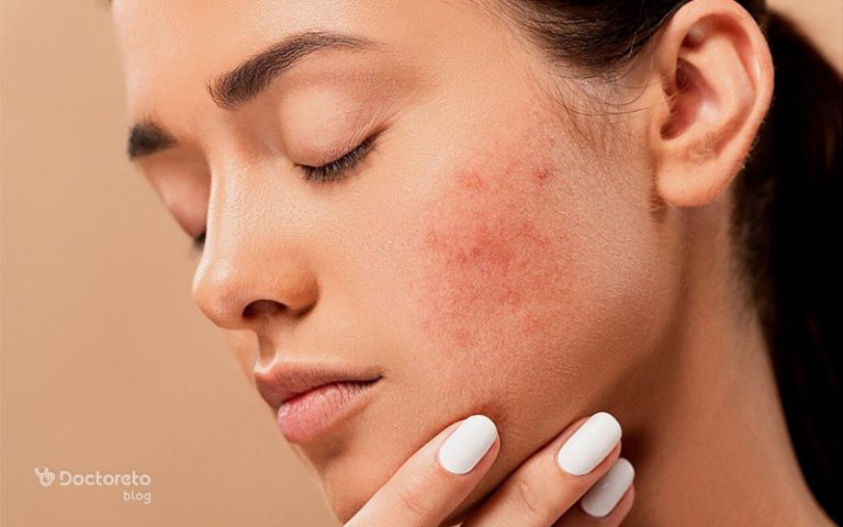 علت جوش های هورمونی چیست؟ شکل ظاهری و درمان آنها