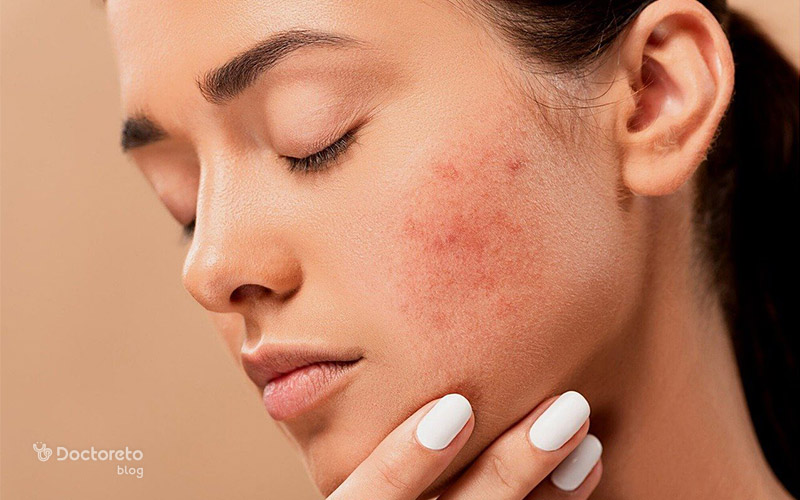 علت آکنه هورمونی چیست؟