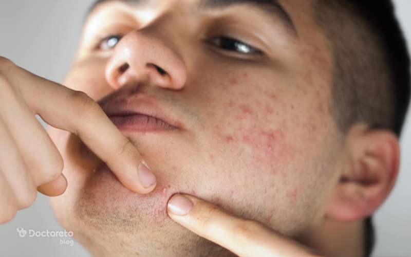 جوش بلوغ چه تفاوتی با جوش‌های معمولی دارد؟