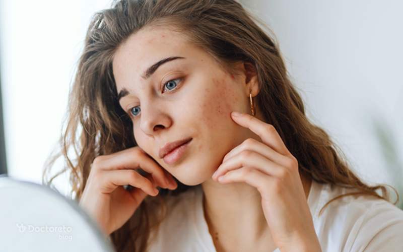 جوش بلوغ چه علائمی دارد؟