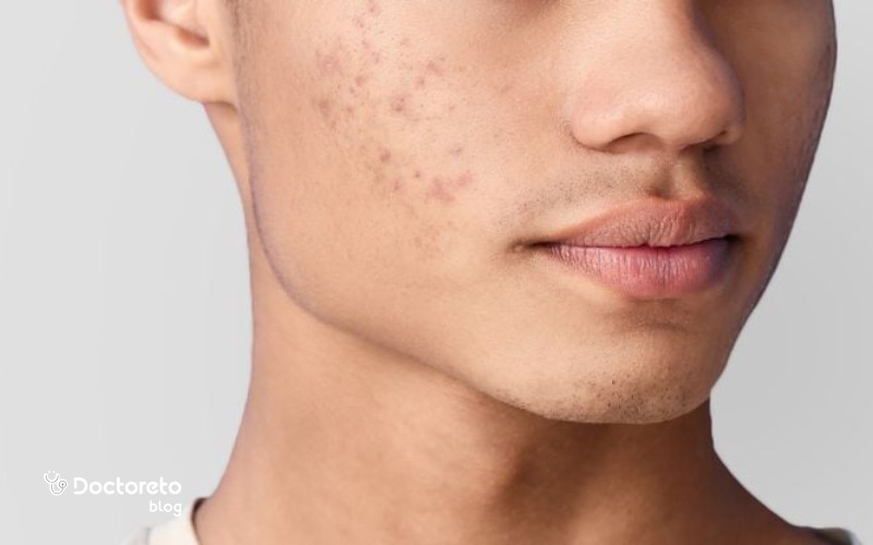 بهترین پماد برای جوش بلوغ صورت کدام است؟