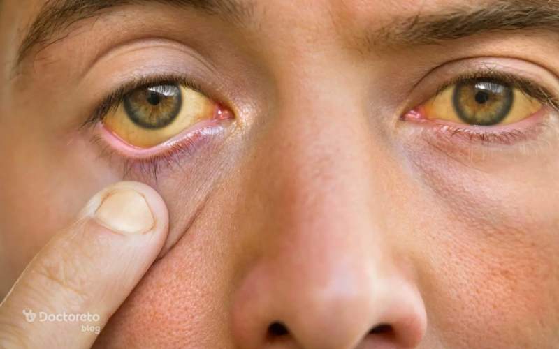 مهم‌ترین علل زردی چشم چیست؟