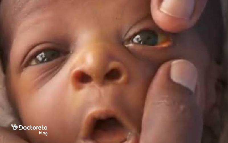 زردی چشم نوزاد تا کی ادامه دارد؟