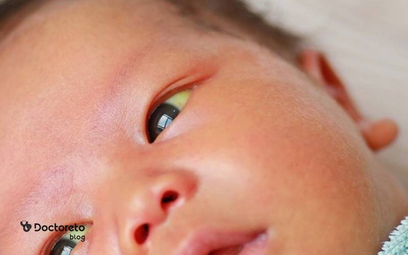 عکس زردی چشم نوزاد