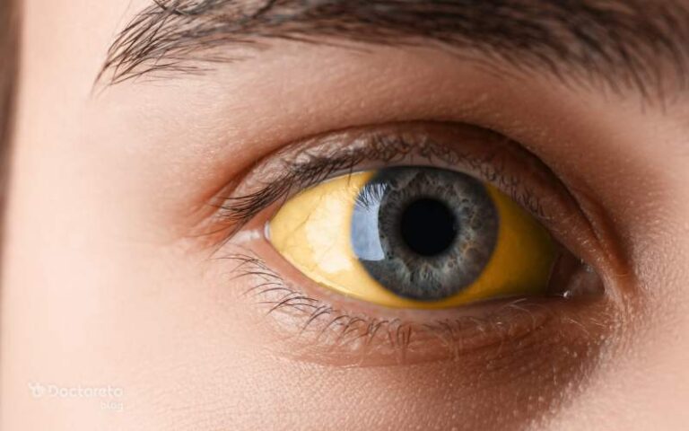 علت زردی چشم چیست؟ کدام بیماریها باعث زردی چشم میشوند؟