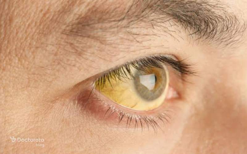 زردی چشم نشانه چه بیماری است؟
