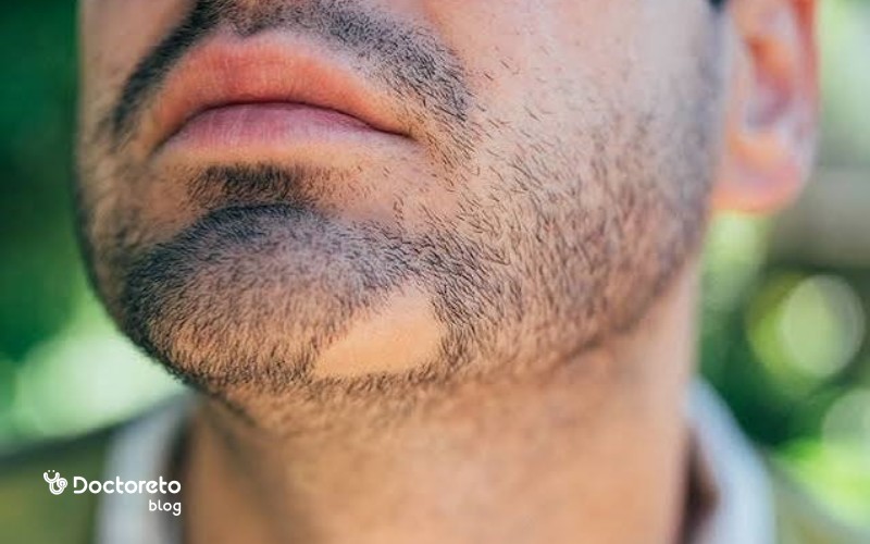علت ریزش مو سکه‌ای در ریش چیست؟