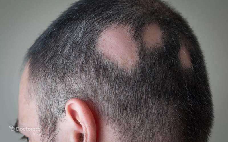 آیا دمنوش‌های گیاهی می‌توانند ریزش موی سکه‌ای را درمان کنند؟