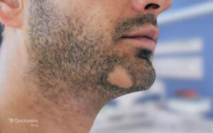 آیا درمان خانگی ریزش مو سکه ای موثر است؟