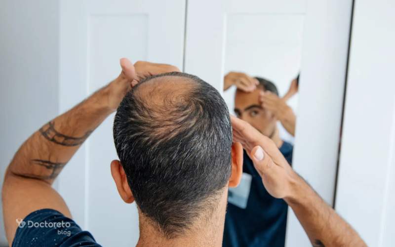 آیا نازک شدن تدریجی موها نشانه مشکلات هورمونی است؟