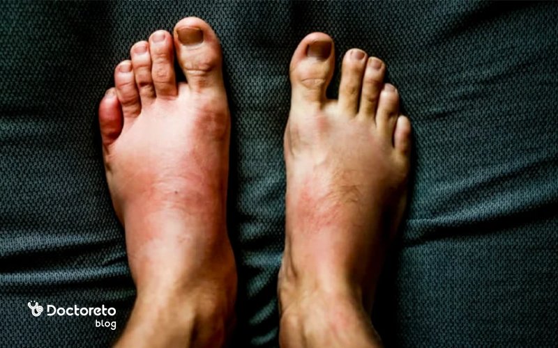 ورم پای کبدی چه نشانه‌ها و شکل ظاهری دارد؟