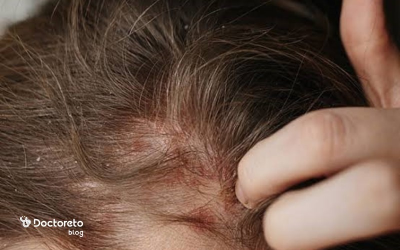 آیا چرخه طبیعی رشد مو باعث ریزش موقت بعد از PRP میشود؟