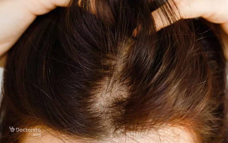کدام داروهای موضعی برای ریزش موی سکه ای زنان خوب است؟