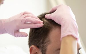 دلیل ریزش مو سکه ای چیست؟ بررسی تمامی علل شایع