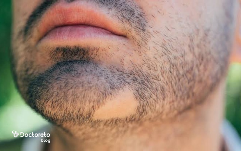 دلیل ریزش مو سکه‌ای ریش چیست؟
