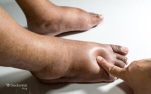 ورم پا دیابتی و نکات مهم و هشداردهنده آن